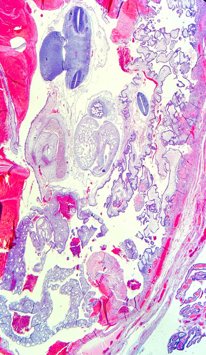 Janiranavarro's tweet photo. Ectopic pregnancy with fetal parts and yolk sac remnant (or simply yolk sac), Pic 1

It is not common to see a yolk sac in a POC specimen or even in ectopic pregnancy. It looks concerning, but once you see one, you'll recognize it faster next time.

Yolk sac, high power (Pic 2)

For the best educational thread on yolk sac, check @leon_metlay's post: https://t.co/wNu2SXpYqe

Another yolk sac post from Dr. Kaur's ISGYP presentation: https://t.co/x8H67pzXBZ

#everydayGYN #PathX #pathtwitter