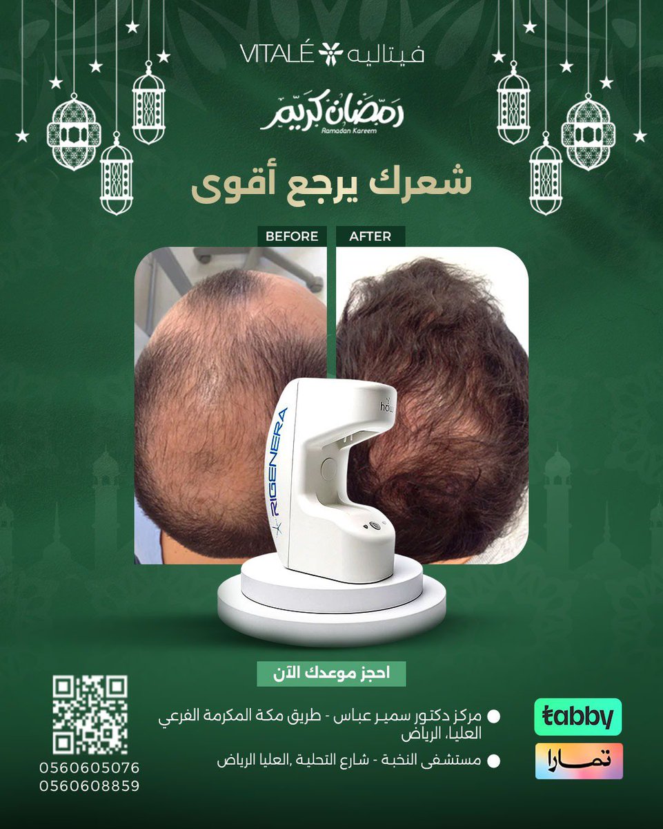 vitaleclinics's tweet photo. التساقط ما يوقف؟

الريجينيرا من أحدث التقنيات تعيد كثافة شعرك من الجذور بجلسة واحدة 🤍

في فيتاليه نوفّر أحدث التقنيات بإشراف طبي متخصص يضمن لك
نتيجة طبيعية وآمنة 

احجز الآن

#كثافة_الشعر#تساقط_الشعر#علاج_تساقط_الشعر#��لريجينيرا#فيتاليه https://t.co/keq6gYaXXY