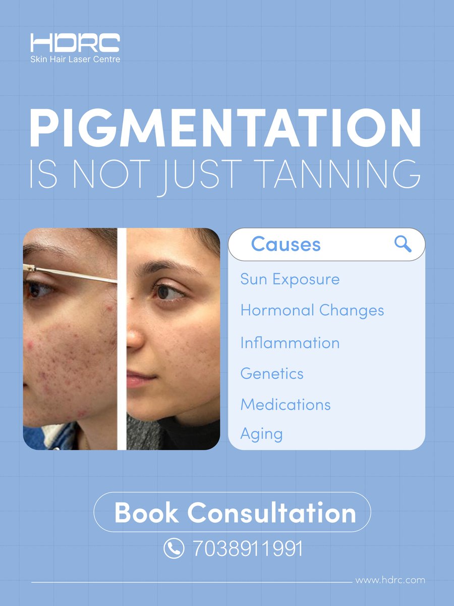 hdrchospital's tweet photo. Pigmentation is NOT just tanning | HDRC Hospital 

Our expert team offers safe and effective treatments tailored to your skin type.

Book your consultation today: 7038911991
Experience professional skin care you can trust
#skincare #tanfreeskin #skintreatment #hdrchospital https://t.co/cGoxmKjofz