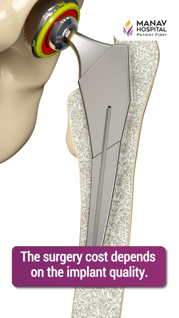 ✅Total Hip Replacement Cost | हिप रिप्लेसमेंट में कितना खर्चा आता है 😱Best Hip Implant 
.
.
#HipReplacement #HipReplacementCost #HipPain #Orthopedic #JointPain #Arthritis #TotalHipReplacement #MobilityRestored #DoctorAdvice  #shorts
youtube.com/shorts/EbufsQW…