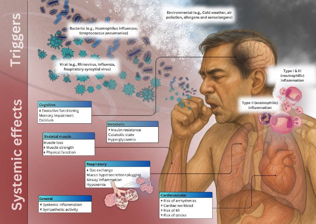 The systemic effects of acute exacerbations of COPD doi.org/10.1183/231205… <a href="/ERSpublications/">ERS publications</a>