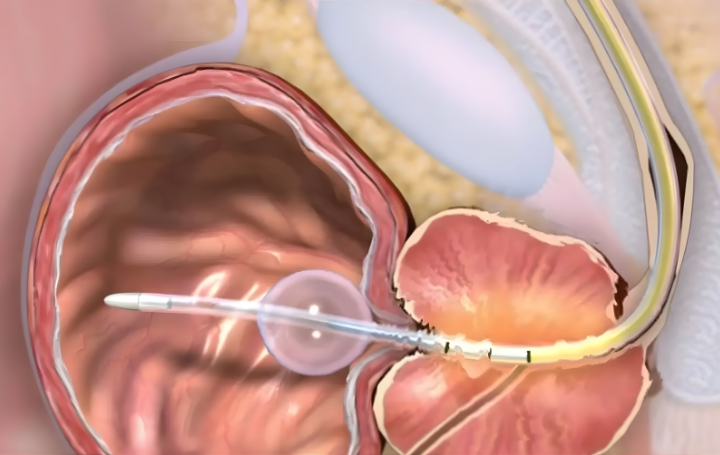 prostatameliyat's tweet photo. Transüretral mikrodalga tedavisi (TUMT) nedir, nasıl yapılır, kimler için uygundur? Prostat büyümesinde TUMT avantajları, dezavantajları ve iyileşme süreci hakkında güncel rehber.

https://t.co/PlRlukqEAJ https://t.co/m5wPO75cFJ