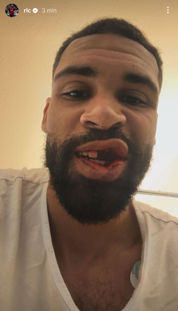 Frattura della mascella, ma è stato fischiato fallo contro Loftus-Cheek in area del Parma. 

(foto Ig Loftus-Cheek)