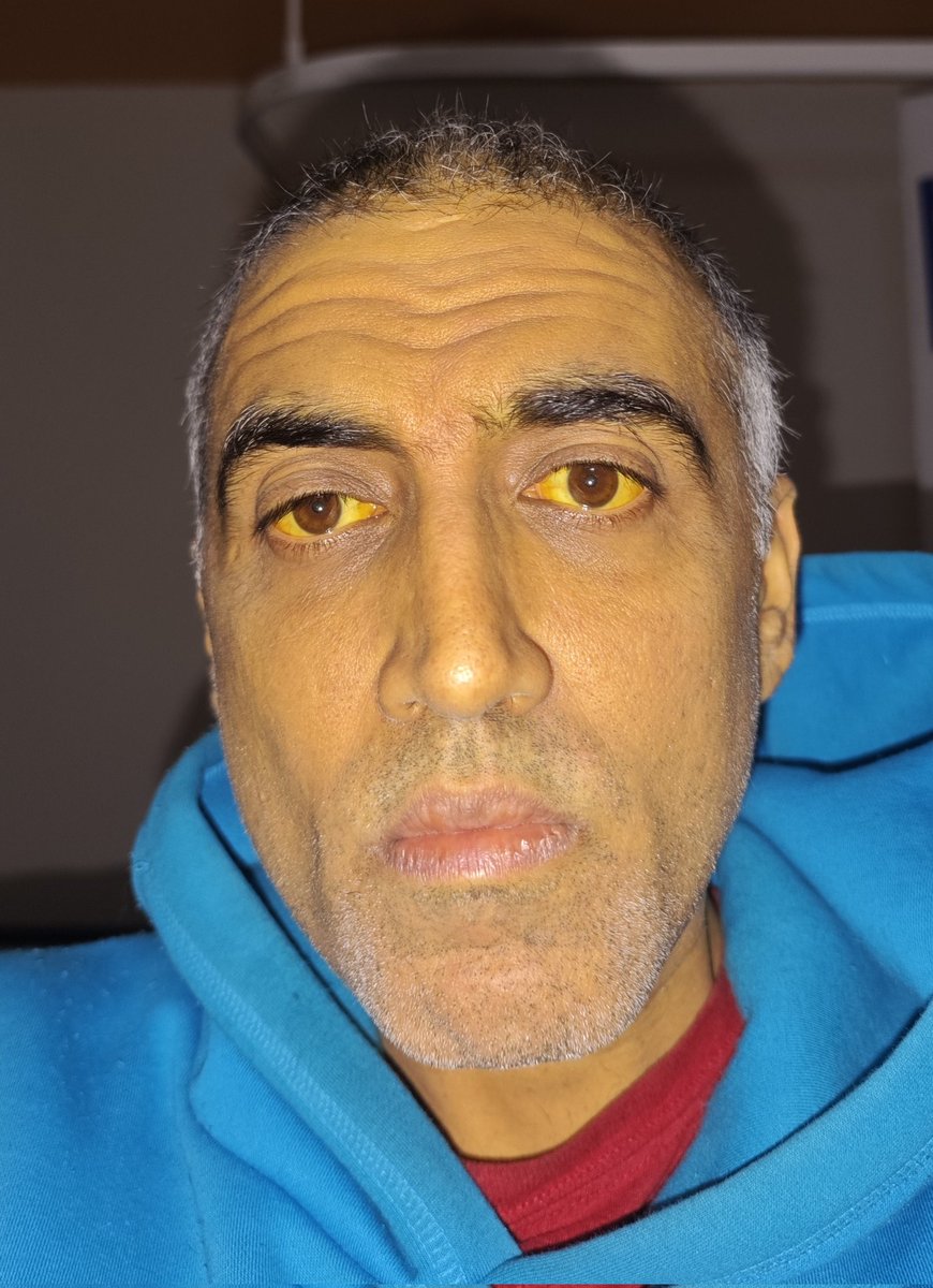 Sadly my bilirubin continues to rise.....507 now. If it keeps heading up it'll be transplant territory 😭. Had liver biopsy today, was painful and uncomfortable, hopefully gives some answers. Still as yellow as Bart Simpson