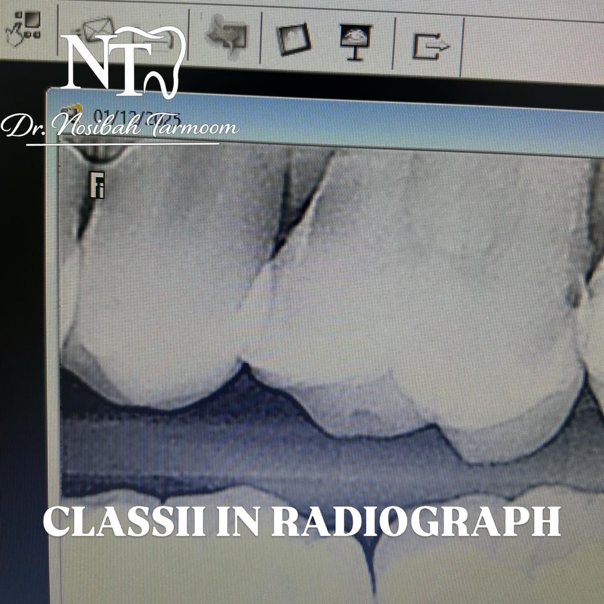 Class II composite restoration performed on tooth #26 mesially .Caries removal followed by composite resin restoration.