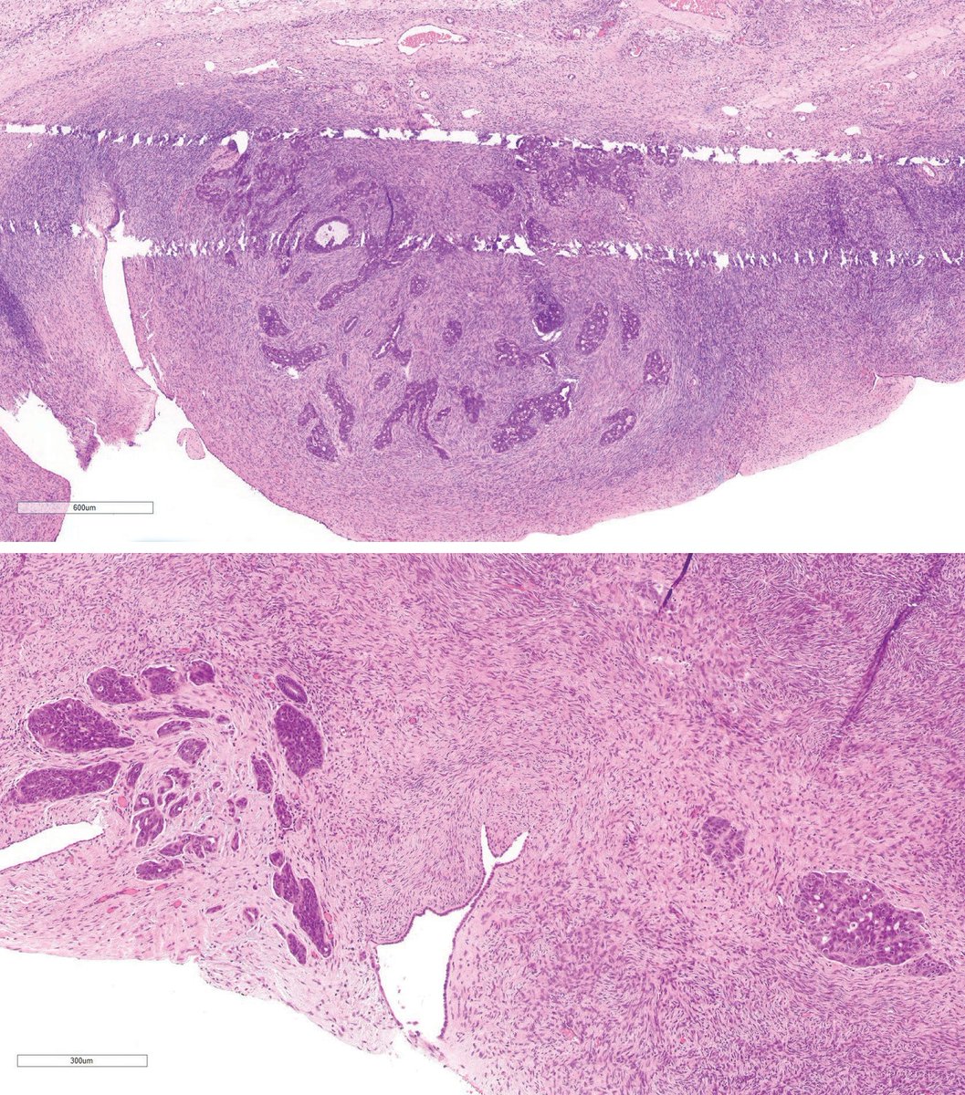 Ovarian Cancer- Another Developmental PathwayThere are several pathways for ovarian cancer to develop, and they are different according to the type of epithelial tumor. However, there is one pathway that is common to all five different tumor types, that is, when the tumor