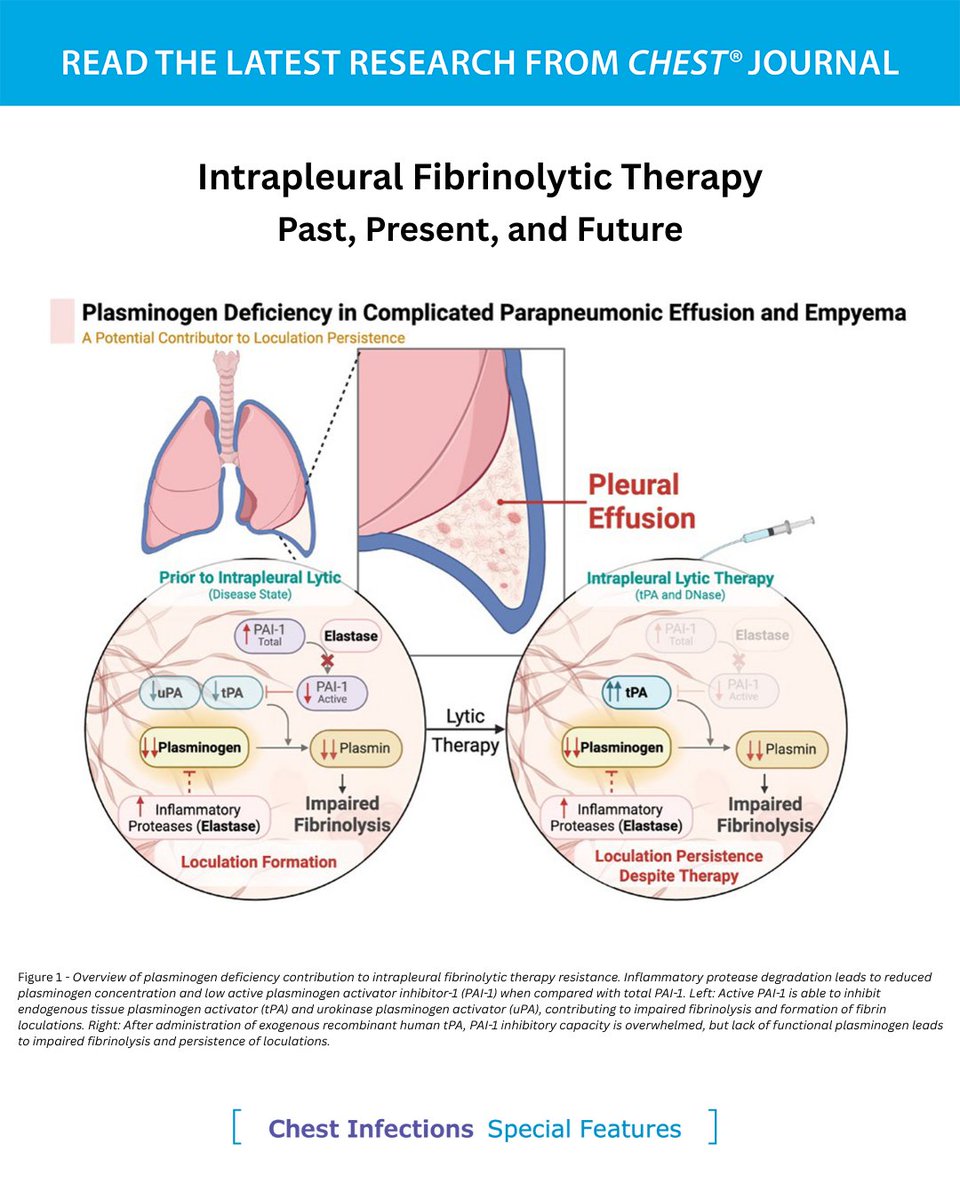 journal_CHEST's tweet photo. A CHEST Special Features article explores the past, present, and future of intrapleural fibrinolytic therapy.

Read more in the February issue of the journal CHEST®: https://t.co/HgGNt46FKs
#MedEd #JournalCHEST https://t.co/E0iQRtKYmj