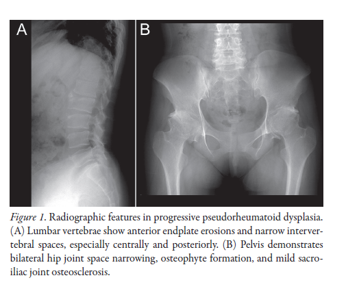 jrheum's tweet photo. Images in Rheumatology

An Uncommon Mimic of Spondyloarthritis

📖 https://t.co/QGAH5tuqVk

#ProgressivePseudorheumatoidDysplasia https://t.co/SeQ7q0598w