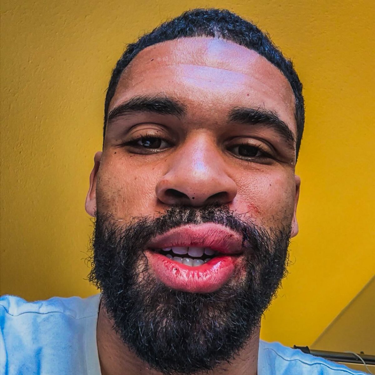 🤕🗣️ Ruben Loftus-Cheek before and after his surgery for a factured jaw! Speedy recovery to him. ❤️‍🩹