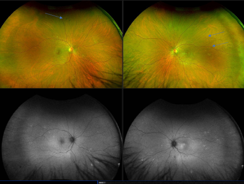 revoptom's tweet image. Multiple Ophthalmic Conditions May Be Caused by Preeclampsia

The complication affects up to 8% of pregnancies, and new research explores its connection to related eye problem.

reviewofoptometry.com/article/multip…

#eyecare #preeclampsia #hypertension #retinopathy