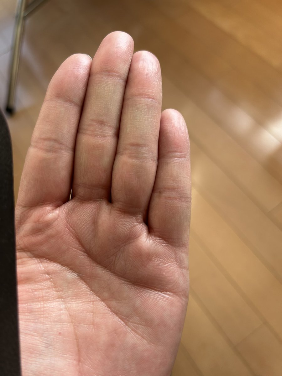 sticker_fan's tweet photo. これってフィッシュかなぁ？わかる方教えてください！　#手相　#フィッシュ　#太陽丘 https://t.co/d9BmUvrHUc