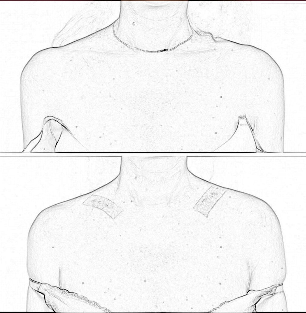 PK867007's tweet photo. Shoulder contouring surgery creates smoother, softer shoulder–neck lines, reduces the appearance of broad or prominent shoulders, and enhances overall balance and elegance. https://t.co/CLDBDP68la