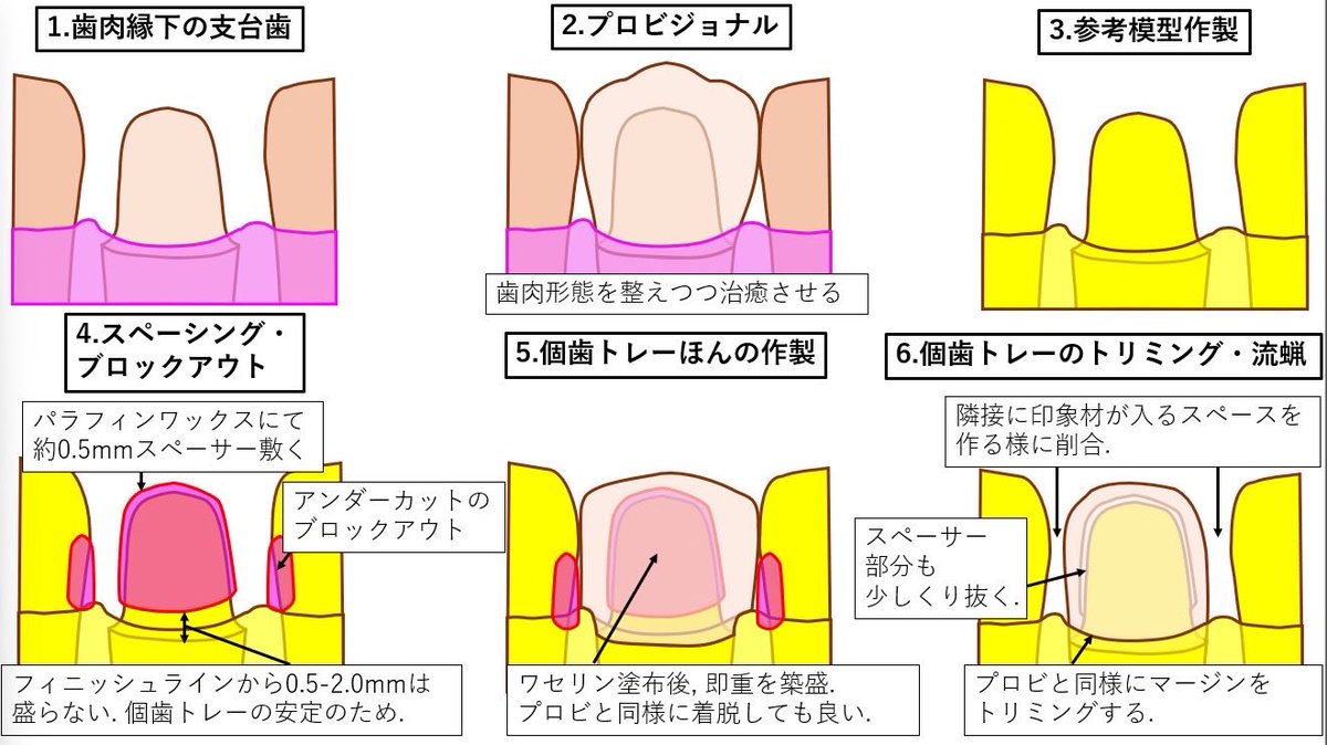 kawazoinoshiro's tweet photo. 個歯トレーの作製方法およびそれを用いたシリコーン印象材での精密印象方法をシェーマですがまとめてみました
今回の症例には間に合わないかもしれないですが、今後の参考になれば幸いです

某国立大学だとピンクの即重で作製しないと叱られます😂 https://t.co/JVnuc18MuP
