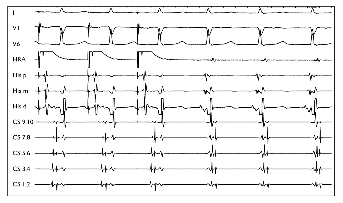 DrRoderickTung's tweet image. How good is today's AI to replace #EPeeps? Fascinated by steep progression of Seedance 2.0, AI hospitals in China, and @elonmusk comment on medical schools.

I asked for an interpretation of this atrial overdrive pacing with a pseudo-AHHV response to Gemini, Grok, and Chat GPT...