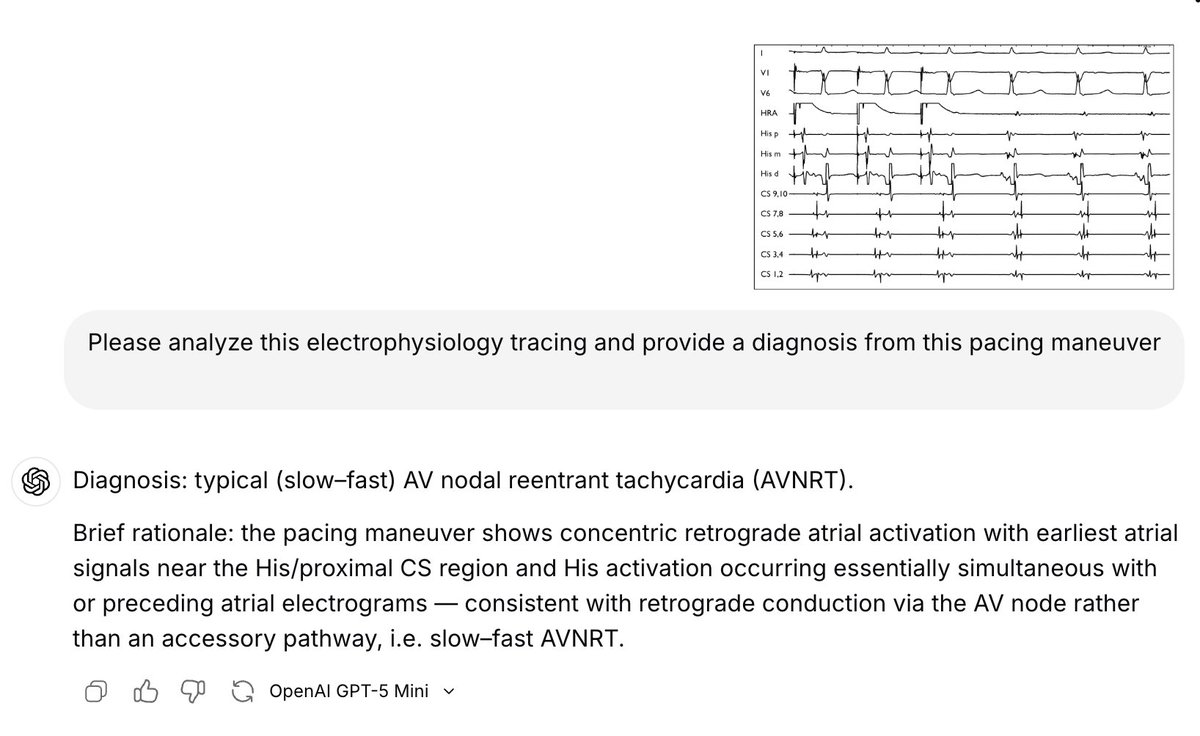 DrRoderickTung's tweet image. How good is today's AI to replace #EPeeps? Fascinated by steep progression of Seedance 2.0, AI hospitals in China, and @elonmusk comment on medical schools.

I asked for an interpretation of this atrial overdrive pacing with a pseudo-AHHV response to Gemini, Grok, and Chat GPT...