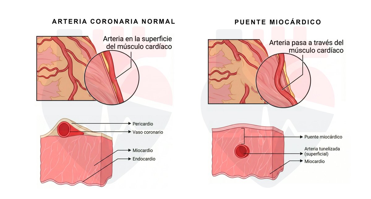 En condiciones normales, las arterias coronarias discurren por la superficie del corazón 🫀

Pero a veces, un segmento puede tener un trayecto dentro del músculo cardiaco.

A esto lo llamamos puente miocárdico.

Y en el hilo de hoy te contamos todo lo que necesitas saber 👇🏼📚