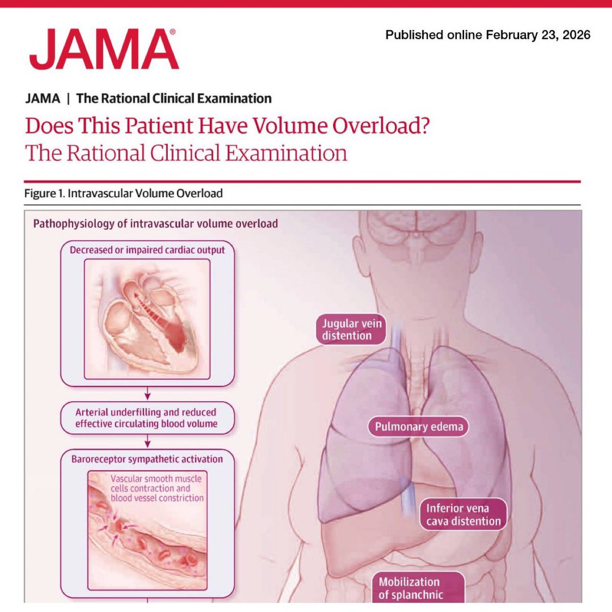 abouabdrahman0's tweet photo. Volume Overload – 50 High-Yield Pearls 💧🫀📚
Based on: Drum et al., JAMA 2026 – The Rational Clinical Examination  

⸻

1️⃣ Volume overload = intravascular sodium + water expansion 💧
2️⃣ Think: HF, CKD, cirrhosis, excess IV fluids 🏥
3️⃣ Pathophysiology: arterial underfilling → RAAS activation 🔄
4️⃣ Plasma volume expansion → ↑ hydrostatic pressure 📈
5️⃣ Peripheral edema = filtration > lymphatic drainage 🦵
6️⃣ Hypoalbuminemia ↓ oncotic pressure → worsens edema 🧪
7️⃣ Edema grading (0–4+) = subjective ⚠️ low reproducibility
8️⃣ Bilateral symmetric pitting → systemic cause 🦵🦵
9️⃣ Crackles = reopening of fluid-filled airways 🎧
🔟 Kerley B lines on CXR = interlobular septal edema 📸

1️⃣1️⃣ JVP >3 cm above sternal angle → LR+ 4.1 🎯
1️⃣2️⃣ JVD highly specific (~92%) but poorly sensitive ❗
1️⃣3️⃣ Lower extremity edema → LR+ 2.2
1️⃣4️⃣ Edema absence does NOT exclude overload 🚫
1️⃣5️⃣ Crackles → LR+ 2.7
1️⃣6️⃣ Absence of crackles insufficient to rule out ❌
1️⃣7️⃣ Physical exam = specific, not sensitive
1️⃣8️⃣ Best PE tool = JVP
1️⃣9️⃣ Obesity reduces PE accuracy ⚖️
2️⃣0️⃣ Combine signs, don’t rely on one

2️⃣1️⃣ Chest X-ray vascular congestion → LR+ 5.9 📸🔥
2️⃣2️⃣ Highly specific (~91%)
2️⃣3️⃣ Sensitivity modest (~51%)
2️⃣4️⃣ Peribronchial cuffing = pulmonary vascular congestion
2️⃣5️⃣ Hazy perihilar opacities suggest edema

2️⃣6️⃣ BNP ≥100 ng/mL → LR+ 6.9 🧪🔥
2️⃣7️⃣ BNP <100 → LR− 0.14 ✅ strong rule-out
2️⃣8️⃣ BNP sensitivity ~87%
2️⃣9️⃣ BNP specificity ~87%
3️⃣0️⃣ Obesity lowers BNP levels ⚖️
3️⃣1️⃣ Age & renal failure increase BNP 📈
3️⃣2️⃣ BNP best single lab predictor 🎯
3️⃣3️⃣ NT-proBNP cutoffs heterogeneous
3️⃣4️⃣ Lab results not immediate but rapid in ED settings
3️⃣5️⃣ BNP helpful in dyspnea differentiation 💨

3️⃣6️⃣ Lung POCUS: ≥3 B-lines in ≥2 bilateral zones = positive 📡
3️⃣7️⃣ B-lines LR+ 4.0
3️⃣8️⃣ Absence of B-lines LR− 0.09 🚀 very powerful rule-out
3️⃣9️⃣ Lung POCUS sensitivity 93% 💡
4️⃣0️⃣ B-lines not specific (ARDS/pneumonia possible)

4️⃣1️⃣ IVC >2.1 cm + <50% collapse → LR+ 3.9
4️⃣2️⃣ IVC ≥50% collapse → LR− 0.22
4️⃣3️⃣ Measure 2 cm from RA junction 📏
4️⃣4️⃣ Positive pressure ventilation alters IVC ⚠️
4️⃣5️⃣ Ascites affects interpretation

4️⃣6️⃣ POCUS JVP >8 cm → LR+ 2.8
4️⃣7️⃣ POCUS JVP ≤8 cm → LR− 0.26
4️⃣8️⃣ Ultrasound JVP more sensitive than bedside JVP
4️⃣9️⃣ POCUS generates preservable objective images 📷
5️⃣0️⃣ Best exclusion combo: BNP <100 OR no B-lines ✅

⸻

🔑 Top Performers
•🔥 BEST single positive test: BNP ≥100
•🔥 BEST radiographic test: vascular congestion on CXR
•🔥 BEST rule-out tool: absence of B-lines

⸻

📚 Source:
Drum B, La Course B, Kelly M, et al. Does This Patient Have Volume Overload? JAMA. Published Feb 23, 2026.  
DOI: 10.1001/jama.2026.0446