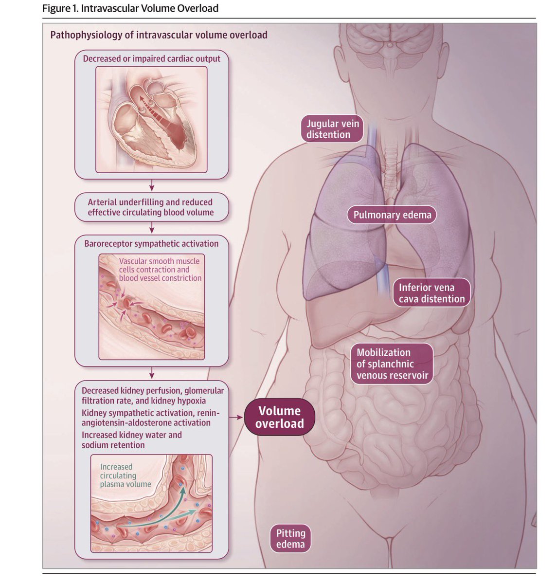abouabdrahman0's tweet photo. Volume Overload – 50 High-Yield Pearls 💧🫀📚
Based on: Drum et al., JAMA 2026 – The Rational Clinical Examination  

⸻

1️⃣ Volume overload = intravascular sodium + water expansion 💧
2️⃣ Think: HF, CKD, cirrhosis, excess IV fluids 🏥
3️⃣ Pathophysiology: arterial underfilling → RAAS activation 🔄
4️⃣ Plasma volume expansion → ↑ hydrostatic pressure 📈
5️⃣ Peripheral edema = filtration > lymphatic drainage 🦵
6️⃣ Hypoalbuminemia ↓ oncotic pressure → worsens edema 🧪
7️⃣ Edema grading (0–4+) = subjective ⚠️ low reproducibility
8️⃣ Bilateral symmetric pitting → systemic cause 🦵🦵
9️⃣ Crackles = reopening of fluid-filled airways 🎧
🔟 Kerley B lines on CXR = interlobular septal edema 📸

1️⃣1️⃣ JVP >3 cm above sternal angle → LR+ 4.1 🎯
1️⃣2️⃣ JVD highly specific (~92%) but poorly sensitive ❗
1️⃣3️⃣ Lower extremity edema → LR+ 2.2
1️⃣4️⃣ Edema absence does NOT exclude overload 🚫
1️⃣5️⃣ Crackles → LR+ 2.7
1️⃣6️⃣ Absence of crackles insufficient to rule out ❌
1️⃣7️⃣ Physical exam = specific, not sensitive
1️⃣8️⃣ Best PE tool = JVP
1️⃣9️⃣ Obesity reduces PE accuracy ⚖️
2️⃣0️⃣ Combine signs, don’t rely on one

2️⃣1️⃣ Chest X-ray vascular congestion → LR+ 5.9 📸🔥
2️⃣2️⃣ Highly specific (~91%)
2️⃣3️⃣ Sensitivity modest (~51%)
2️⃣4️⃣ Peribronchial cuffing = pulmonary vascular congestion
2️⃣5️⃣ Hazy perihilar opacities suggest edema

2️⃣6️⃣ BNP ≥100 ng/mL → LR+ 6.9 🧪🔥
2️⃣7️⃣ BNP <100 → LR− 0.14 ✅ strong rule-out
2️⃣8️⃣ BNP sensitivity ~87%
2️⃣9️⃣ BNP specificity ~87%
3️⃣0️⃣ Obesity lowers BNP levels ⚖️
3️⃣1️⃣ Age & renal failure increase BNP 📈
3️⃣2️⃣ BNP best single lab predictor 🎯
3️⃣3️⃣ NT-proBNP cutoffs heterogeneous
3️⃣4️⃣ Lab results not immediate but rapid in ED settings
3️⃣5️⃣ BNP helpful in dyspnea differentiation 💨

3️⃣6️⃣ Lung POCUS: ≥3 B-lines in ≥2 bilateral zones = positive 📡
3️⃣7️⃣ B-lines LR+ 4.0
3️⃣8️⃣ Absence of B-lines LR− 0.09 🚀 very powerful rule-out
3️⃣9️⃣ Lung POCUS sensitivity 93% 💡
4️⃣0️⃣ B-lines not specific (ARDS/pneumonia possible)

4️⃣1️⃣ IVC >2.1 cm + <50% collapse → LR+ 3.9
4️⃣2️⃣ IVC ≥50% collapse → LR− 0.22
4️⃣3️⃣ Measure 2 cm from RA junction 📏
4️⃣4️⃣ Positive pressure ventilation alters IVC ⚠️
4️⃣5️⃣ Ascites affects interpretation

4️⃣6️⃣ POCUS JVP >8 cm → LR+ 2.8
4️⃣7️⃣ POCUS JVP ≤8 cm → LR− 0.26
4️⃣8️⃣ Ultrasound JVP more sensitive than bedside JVP
4️⃣9️⃣ POCUS generates preservable objective images 📷
5️⃣0️⃣ Best exclusion combo: BNP <100 OR no B-lines ✅

⸻

🔑 Top Performers
•🔥 BEST single positive test: BNP ≥100
•🔥 BEST radiographic test: vascular congestion on CXR
•🔥 BEST rule-out tool: absence of B-lines

⸻

📚 Source:
Drum B, La Course B, Kelly M, et al. Does This Patient Have Volume Overload? JAMA. Published Feb 23, 2026.  
DOI: 10.1001/jama.2026.0446