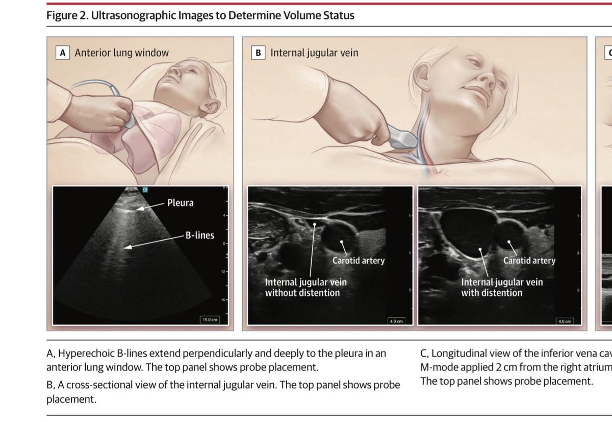 abouabdrahman0's tweet photo. Volume Overload – 50 High-Yield Pearls 💧🫀📚
Based on: Drum et al., JAMA 2026 – The Rational Clinical Examination  

⸻

1️⃣ Volume overload = intravascular sodium + water expansion 💧
2️⃣ Think: HF, CKD, cirrhosis, excess IV fluids 🏥
3️⃣ Pathophysiology: arterial underfilling → RAAS activation 🔄
4️⃣ Plasma volume expansion → ↑ hydrostatic pressure 📈
5️⃣ Peripheral edema = filtration > lymphatic drainage 🦵
6️⃣ Hypoalbuminemia ↓ oncotic pressure → worsens edema 🧪
7️⃣ Edema grading (0–4+) = subjective ⚠️ low reproducibility
8️⃣ Bilateral symmetric pitting → systemic cause 🦵🦵
9️⃣ Crackles = reopening of fluid-filled airways 🎧
🔟 Kerley B lines on CXR = interlobular septal edema 📸

1️⃣1️⃣ JVP >3 cm above sternal angle → LR+ 4.1 🎯
1️⃣2️⃣ JVD highly specific (~92%) but poorly sensitive ❗
1️⃣3️⃣ Lower extremity edema → LR+ 2.2
1️⃣4️⃣ Edema absence does NOT exclude overload 🚫
1️⃣5️⃣ Crackles → LR+ 2.7
1️⃣6️⃣ Absence of crackles insufficient to rule out ❌
1️⃣7️⃣ Physical exam = specific, not sensitive
1️⃣8️⃣ Best PE tool = JVP
1️⃣9️⃣ Obesity reduces PE accuracy ⚖️
2️⃣0️⃣ Combine signs, don’t rely on one

2️⃣1️⃣ Chest X-ray vascular congestion → LR+ 5.9 📸🔥
2️⃣2️⃣ Highly specific (~91%)
2️⃣3️⃣ Sensitivity modest (~51%)
2️⃣4️⃣ Peribronchial cuffing = pulmonary vascular congestion
2️⃣5️⃣ Hazy perihilar opacities suggest edema

2️⃣6️⃣ BNP ≥100 ng/mL → LR+ 6.9 🧪🔥
2️⃣7️⃣ BNP <100 → LR− 0.14 ✅ strong rule-out
2️⃣8️⃣ BNP sensitivity ~87%
2️⃣9️⃣ BNP specificity ~87%
3️⃣0️⃣ Obesity lowers BNP levels ⚖️
3️⃣1️⃣ Age & renal failure increase BNP 📈
3️⃣2️⃣ BNP best single lab predictor 🎯
3️⃣3️⃣ NT-proBNP cutoffs heterogeneous
3️⃣4️⃣ Lab results not immediate but rapid in ED settings
3️⃣5️⃣ BNP helpful in dyspnea differentiation 💨

3️⃣6️⃣ Lung POCUS: ≥3 B-lines in ≥2 bilateral zones = positive 📡
3️⃣7️⃣ B-lines LR+ 4.0
3️⃣8️⃣ Absence of B-lines LR− 0.09 🚀 very powerful rule-out
3️⃣9️⃣ Lung POCUS sensitivity 93% 💡
4️⃣0️⃣ B-lines not specific (ARDS/pneumonia possible)

4️⃣1️⃣ IVC >2.1 cm + <50% collapse → LR+ 3.9
4️⃣2️⃣ IVC ≥50% collapse → LR− 0.22
4️⃣3️⃣ Measure 2 cm from RA junction 📏
4️⃣4️⃣ Positive pressure ventilation alters IVC ⚠️
4️⃣5️⃣ Ascites affects interpretation

4️⃣6️⃣ POCUS JVP >8 cm → LR+ 2.8
4️⃣7️⃣ POCUS JVP ≤8 cm → LR− 0.26
4️⃣8️⃣ Ultrasound JVP more sensitive than bedside JVP
4️⃣9️⃣ POCUS generates preservable objective images 📷
5️⃣0️⃣ Best exclusion combo: BNP <100 OR no B-lines ✅

⸻

🔑 Top Performers
•🔥 BEST single positive test: BNP ≥100
•🔥 BEST radiographic test: vascular congestion on CXR
•🔥 BEST rule-out tool: absence of B-lines

⸻

📚 Source:
Drum B, La Course B, Kelly M, et al. Does This Patient Have Volume Overload? JAMA. Published Feb 23, 2026.  
DOI: 10.1001/jama.2026.0446