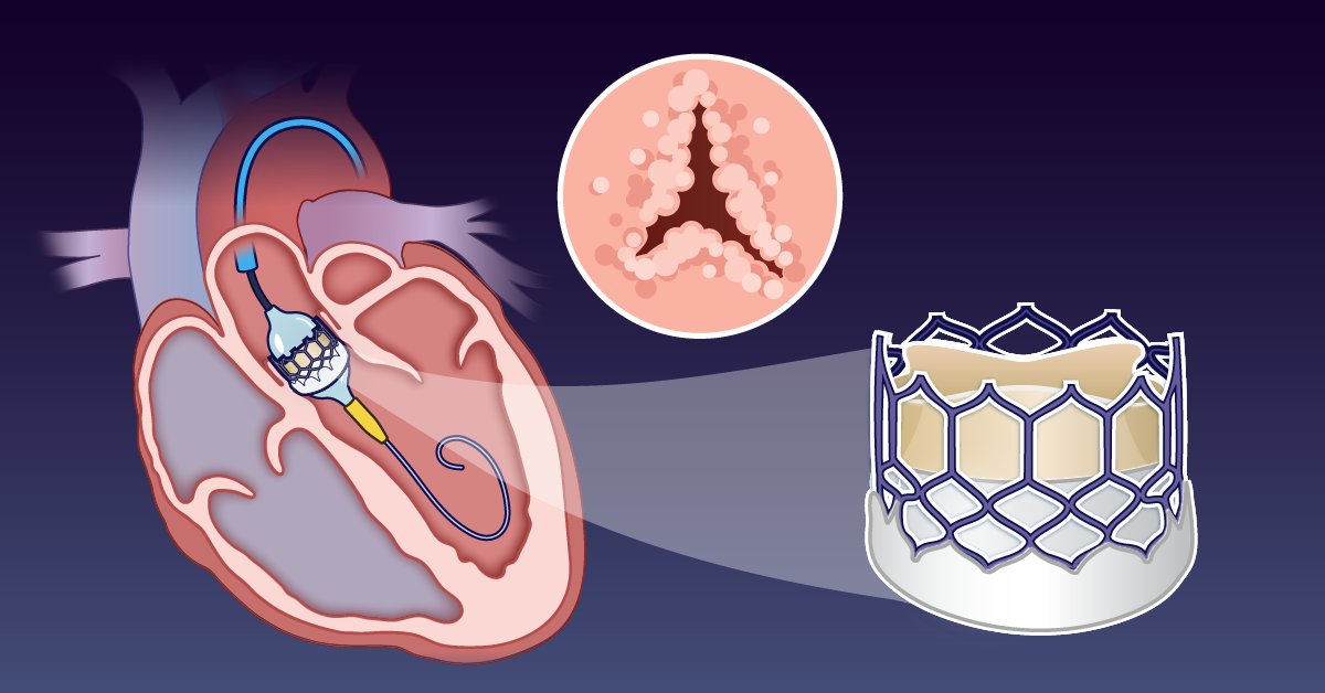 The PARTNER 3 trial showed similar outcomes of transcatheter aortic-valve replacement and surgical aortic-valve replacement for severe, symptomatic aortic stenosis in low-risk patients at 5 years. Now, 7-year findings are summarized in a new Quick Take video.