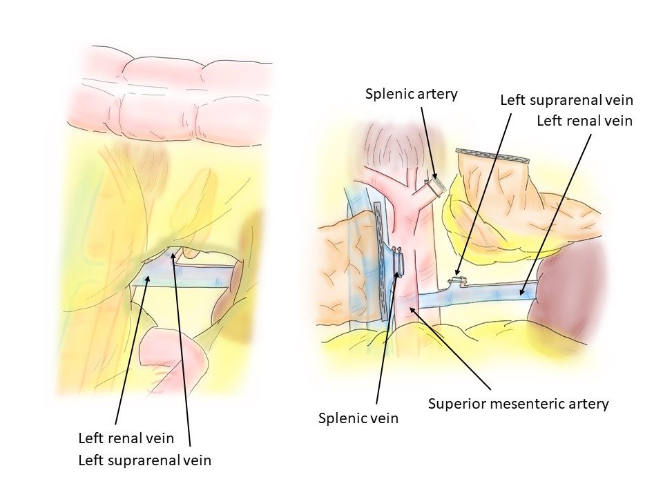 jses_eng's tweet photo. JSES IllustCon 93
📌Safe approach for RAMPS
📝Approach from the most dorsal part of the jejunal origin
🖊Karasudani Ryo
#JSESイラストコンテスト　#JSES_illustration_contest https://t.co/PFqaEhfTm4