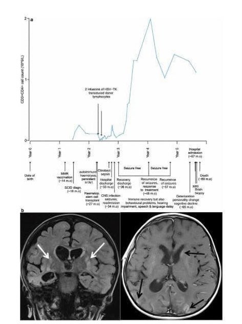 toobaffled's tweet photo. This little boy received the MMR vaccine at 14 months of age. Four months after MMR vaccination, he was diagnosed with SCID (Severe Combined Immune Deficiency Syndrome). He was diagnosed with autoimmune haemolysis and developed a persistent H1N1 infection. He received successful Stem Cell Therapy and his immune system improved, but six months after Stem Cell Therapy he started regressing and losing cognitive abilities, motor skills, and language. He developed seizures. His hearing was affected and he developed personality changes and behavioral changes.

After multiple hospitalizations, he died at 69 months of age.
On autopsy, vaccine-strain mumps virus was found in his brain and this was determined to be the cause of chronic encephalitis - FOUR YEARS AND SEVEN MONTHS AFTER HE WAS VACCINATED.

From the report:
"Using deep sequencing of fresh brain biopsy material, we identiﬁed the Jeryl Lynn 5 mumps virus (MuVJL5), a component of the measles, mumps, rubella (MMR) vaccine that had been administered to the child before the diagnosis of SCID. Similar to ﬁndings in measles viruses recovered from cases of SSPE, the mumps virus genome from the brain showed evidence of biased hypermutation, particularly in the matrix (M) gene. Comparison with sequence data from the original vaccine batch used to immunise this child identiﬁed the expansion of variants present at low frequency in the vaccine as well as de novo ﬁxed missense substitutions. This case represents the ﬁrst conclusive demonstration of chronic panencephalitis due to mumps virus." (from the MMR vaccine. And yes... it was the same strain used in both the UK and the US).

Here is the study:
https://t.co/tbjhTnRySx 

Here is the MMR-ii vaccine manufacturer's insert:
https://t.co/il012n6IFV