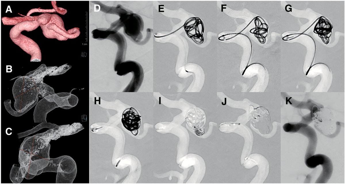 JNET(Journal of Neuroendovascular Therapy) tweet media