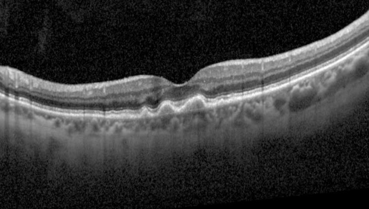 RetinaSociety's tweet photo. Intermediate age-related macular degeneration. https://t.co/afmwQJd4qo