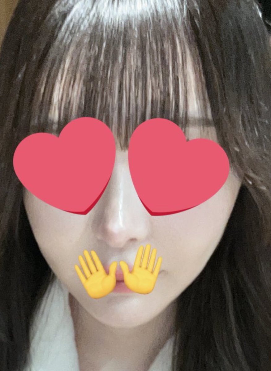 ngm_alkaloid's tweet photo. 皮弛みには糸リフト、切開リフト、クォンタムRF(皮膚に入れて直レーザーめっちゃ怖い)しかないってカウセで言われた。ミニ切開リフトが流行ってるけど下顔面引き上がらないから絶対やらないで。

糸リフトは上手い先生だと半年以上持続するのでおすすめ。左は術前、右は経過5ヶ月。 https://t.co/JuPeQpd0c3