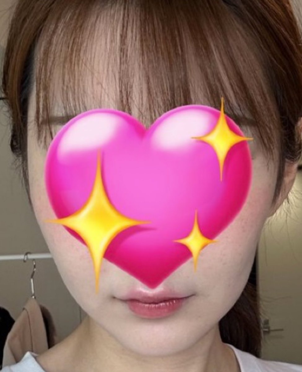 ngm_alkaloid's tweet photo. 皮弛みには糸リフト、切開リフト、クォンタムRF(皮膚に入れて直レーザーめっちゃ怖い)しかないってカウセで言われた。ミニ切開リフトが流行ってるけど下顔面引き上がらないから絶対やらないで。

糸リフトは上手い先生だと半年以上持続するのでおすすめ。左は術前、右は経過5ヶ月。 https://t.co/JuPeQpd0c3