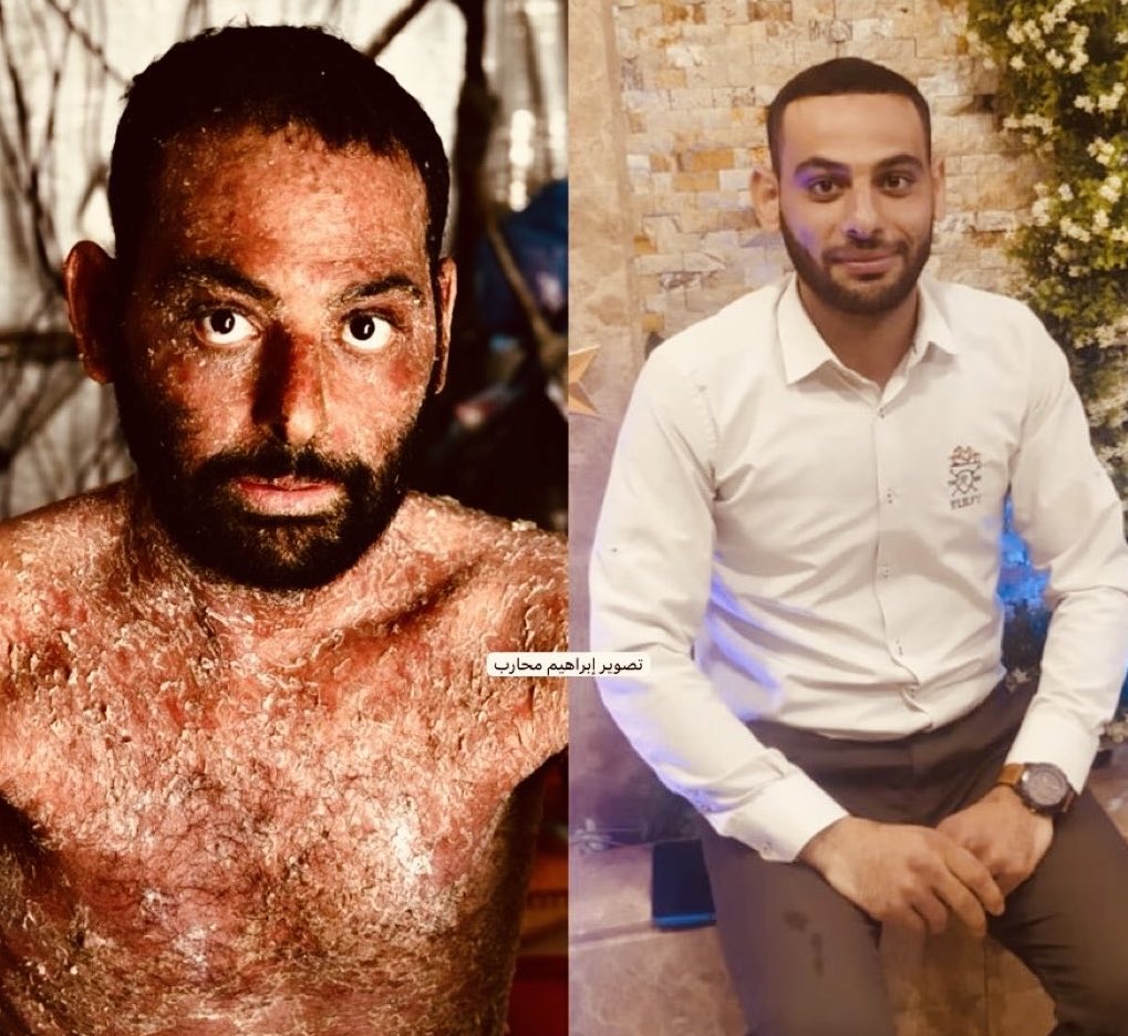 Ibrahim abu Arram from Gaza is suffering from a strange skin rash, and has been waiting for travelling abroad for treatment.. 
This disease has turned his life into hell under continuous Israeli siege..