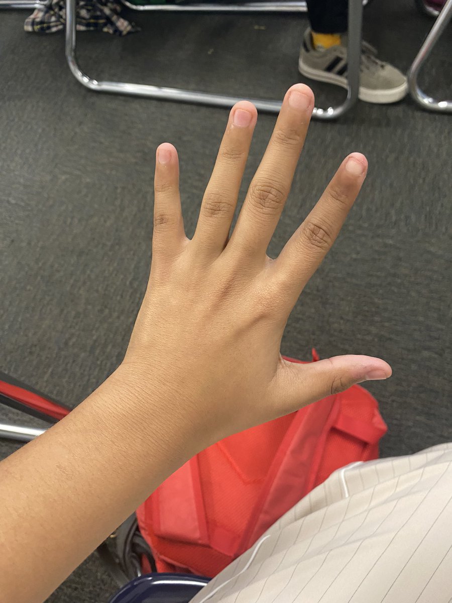chrnicallysilly's tweet photo. hand comparison cuz why not
feels like progress but not a lot

before                                today https://t.co/mD5qRe2ybN