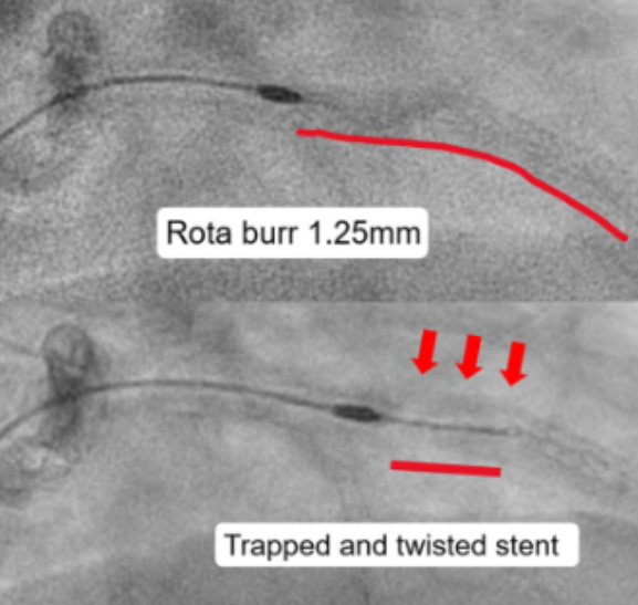 gbiondizoccai's tweet photo. I hope it never happens to me: percutaneous en bloc extraction of a rotablator burr stalled within a stent, with stent and guidewire! https://t.co/xpPZGgJQ8K @ccijournal https://t.co/dm2WkliRTc
