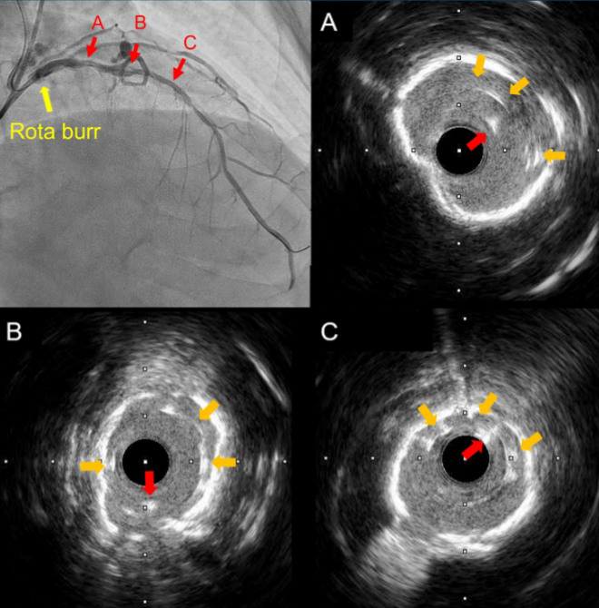 gbiondizoccai's tweet photo. I hope it never happens to me: percutaneous en bloc extraction of a rotablator burr stalled within a stent, with stent and guidewire! https://t.co/xpPZGgJQ8K @ccijournal https://t.co/dm2WkliRTc