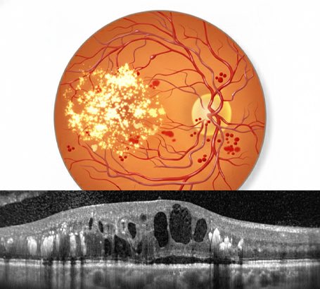EvergreenClubIN's tweet image. Why Protecting Your Central Vision is the Key to Staying Independent
seniorstoday.in/health/why-pro…

Protecting your central vision is essential for maintaining independence.

#visioncare #eyehealth #healthyaging #independentliving #seniorwellness #wellbeing #healthtips