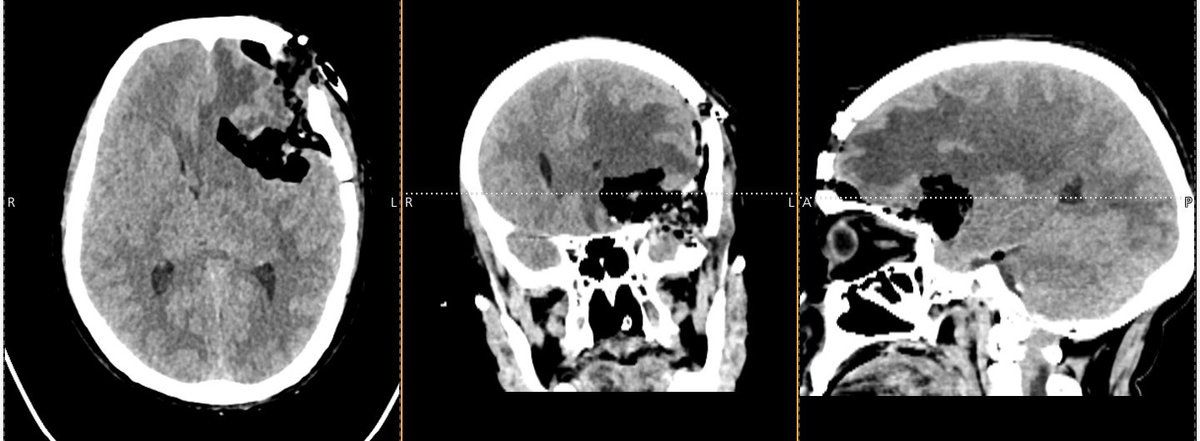 KothiwalaNeal's tweet photo. Patient improved after surgery. https://t.co/fIhsWTYUXt