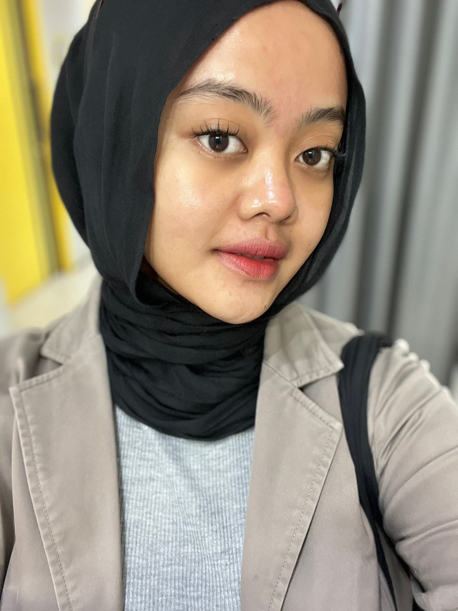 lovefdks's tweet photo. DNA salmon murah meriah yang bikin nagih bgttttt. btw ini udh kali kedua akuu treatment facial DNA salmon😭👍🏻

before                        after https://t.co/MAdt6gV4x5