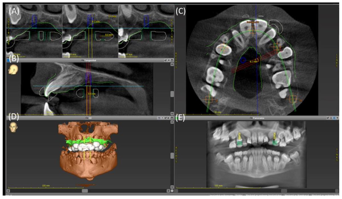 Bioeng_MDPI's tweet image. 💥Highly recommended publication: "Mini-Implant Insertion Using a Guide Manufactured with Computer-Aided Design and Computer-Aided Manufacturing in an Adolescent Patient Suffering from Tooth Eruption Disturbance"
🔗shorturl.at/tO0JJ
🏫@uni_tue 
📌#DigitalDentistry