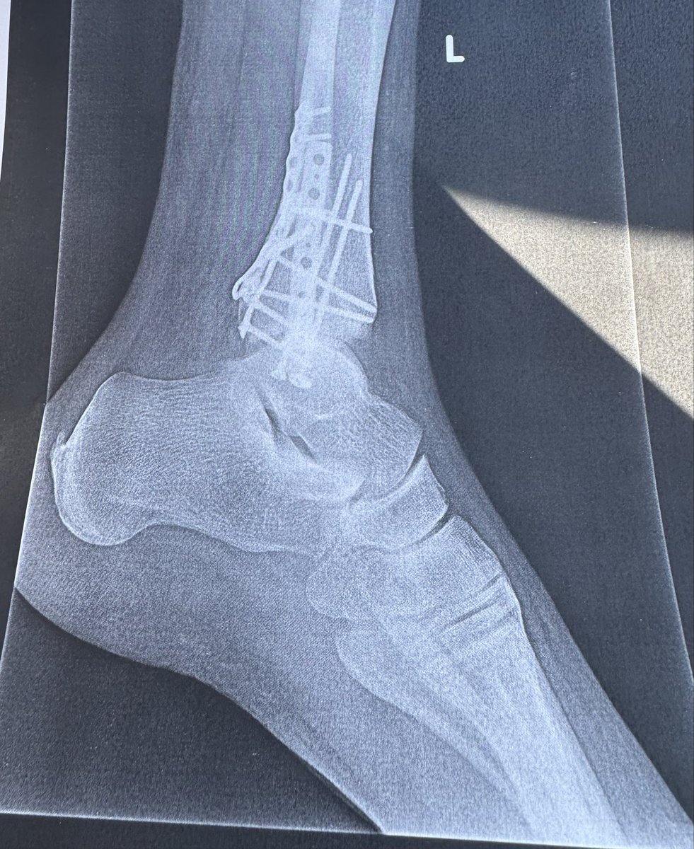 niteowl660's tweet photo. trimalleolar fracture. That’s something I had never heard of until a few weeks ago. Thank to the ice storm and me being in a hurry I was introduced to it. What’s everyone’s experience with this? https://t.co/6a1mHhYfxf