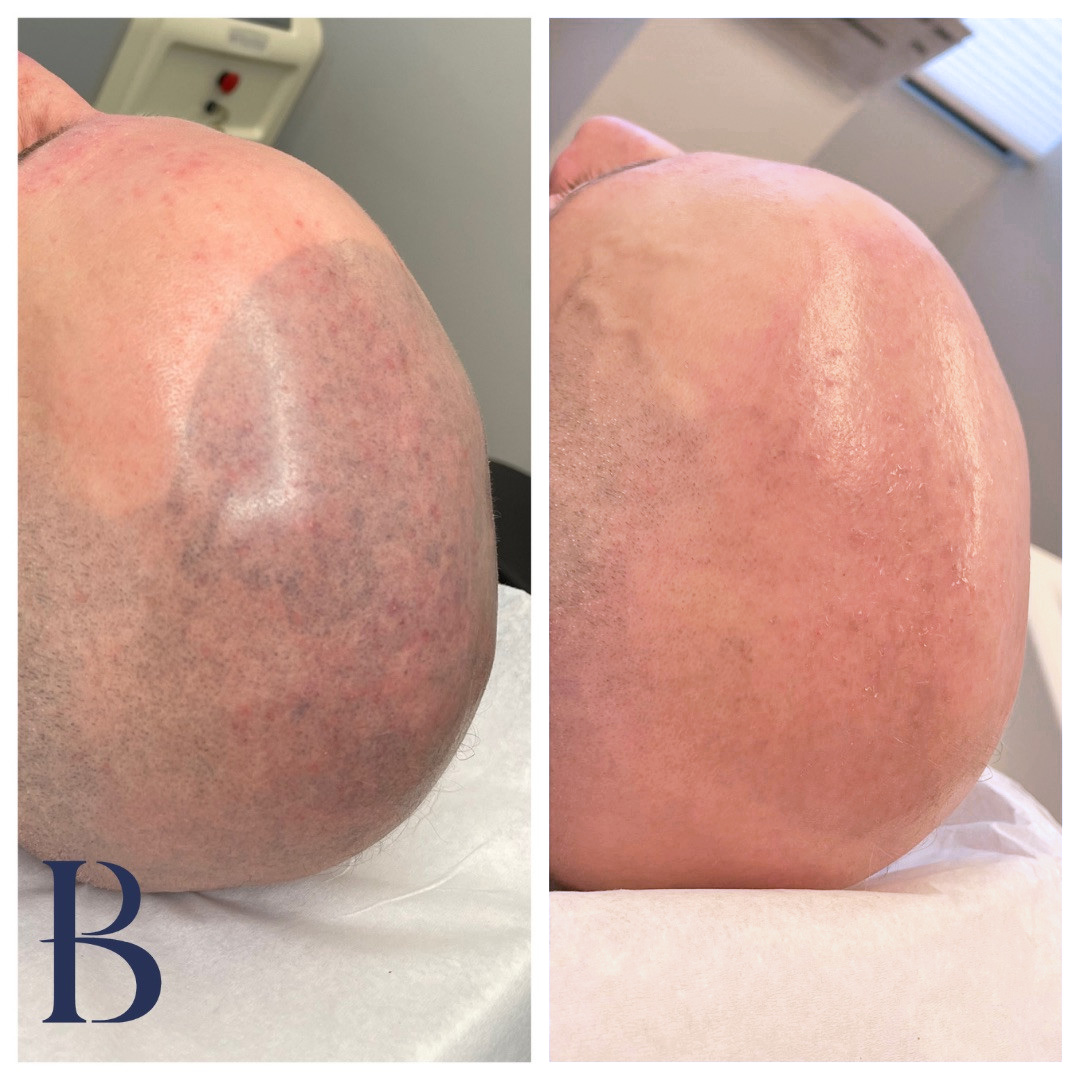 CandelaMedical1's tweet photo. Impressive results here from Project Be.u.te 👏

Using the PicoWay laser, they’ve achieved significant clearance of their client’s PMU SMP in just one session — as shown across these four images.

A fantastic example of what’s possible with the right device, in the right hands. https://t.co/VpH3DFdUtY