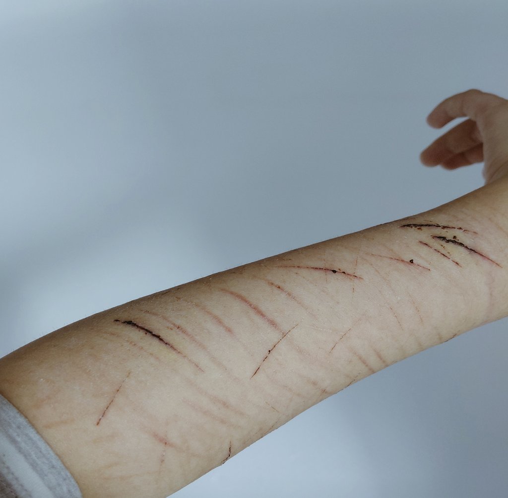 tw/ scars + healing cuts