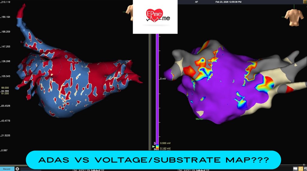 EPmedotme's tweet photo. AF redo case: Adas MRI substrate VS Voltage/Substrate map??? 
What do you feel about Adas in Atrial substrate??? #electrophysiology #epeeps #cardiacablation #adas #cardiacimaging https://t.co/UU9Rv03oUi