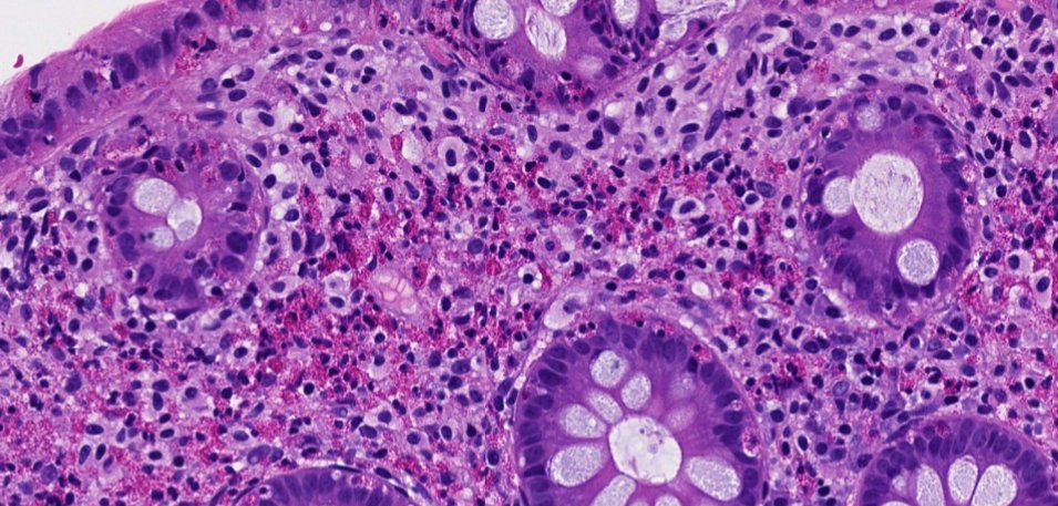 Janiranavarro's tweet photo. Colon - eosinophils
Increased eosinophils in colon should not be dismissed. 
There are cells in the lamina propria that do not appear to be normal lymphocytes or plasma cells, which prompted a CD117 (KIT) stain.
Mast cells show positive staining for CD117
This is a case of systemic mastocytosis involving colonic mucosa

Increased eosinophils in colon, possible etiologies include:
• Drugs / medications
• Inflammatory bowel disease (increased lamina propria lymphocytes, plasma cells and eosinophils)
• Parasitic infections
• Systemic mastocytosis

Dr. Krasinskas - Tips and Hints in Surgical Pathology #USCAP #pathology #PathX