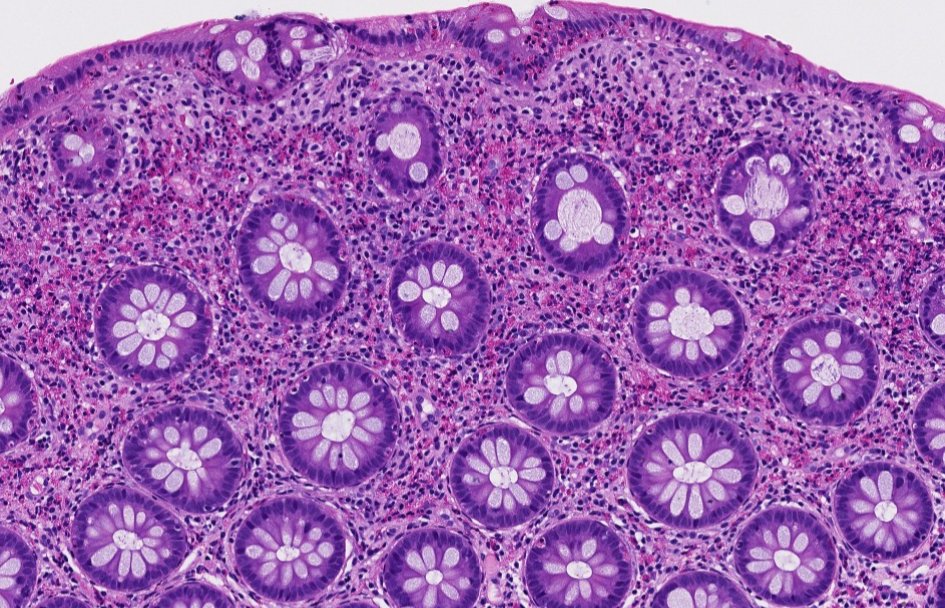 Janiranavarro's tweet photo. Colon - eosinophils
Increased eosinophils in colon should not be dismissed. 
There are cells in the lamina propria that do not appear to be normal lymphocytes or plasma cells, which prompted a CD117 (KIT) stain.
Mast cells show positive staining for CD117
This is a case of systemic mastocytosis involving colonic mucosa

Increased eosinophils in colon, possible etiologies include:
• Drugs / medications
• Inflammatory bowel disease (increased lamina propria lymphocytes, plasma cells and eosinophils)
• Parasitic infections
• Systemic mastocytosis

Dr. Krasinskas - Tips and Hints in Surgical Pathology #USCAP #pathology #PathX