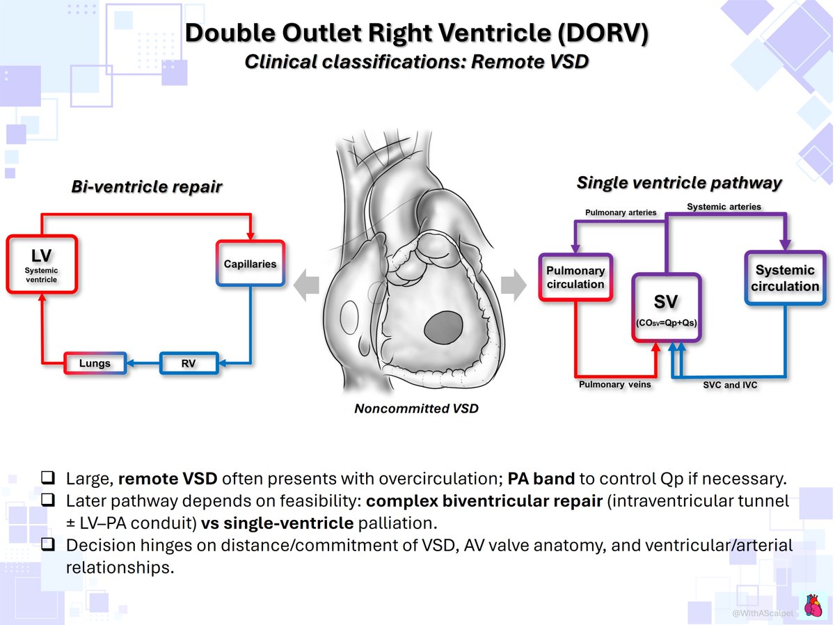 WithAScalpel's tweet photo. DORV #2 — Clinical Classification

DORV is clinically grouped by physiology driven by VSD position and RVOT obstruction:

👉VSD-type (overcirculation, treat like large VSD ± PA band, plan LV–Ao baffle),
👉TOF-type (PS → cyanosis, TOF repair, RVOT relief),
👉TGA-type (subpulmonary streaming, ASO+VSD closure),
👉Remote VSD (complex BiV vs SV).