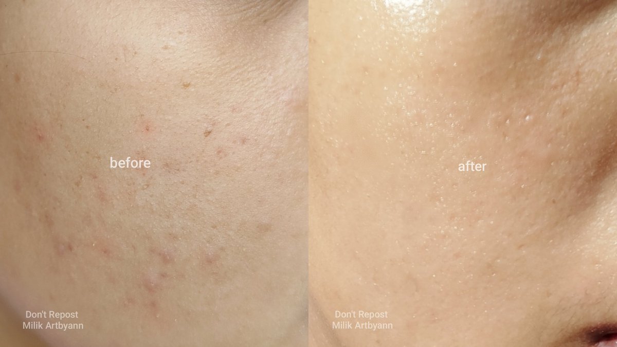 THE P.CALM BARRIER CYCLE TONER PAD — underrated gem ✨

ada yg pakai korean toner pad ini? jujur ini gak terlalu viral, tapi works so well on my skin🥹🫶🏼 this is definitely going to be my repurchase!