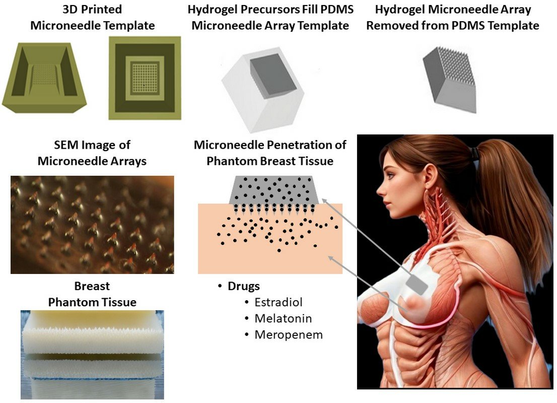 Bioeng_MDPI's tweet image. 💥Highly recommended publication: "Poly(2-Hydroxyethyl Methacrylate) Hydrogel-Based Microneedles for Bioactive Release"
🔗mdpi.com/2306-5354/11/7…
🏫@LancasterUni 
📌#DrugDelivery #BioactiveRelease #MedicalDevices