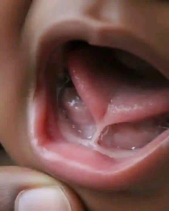 What is this condition called..? 
And the method of removal