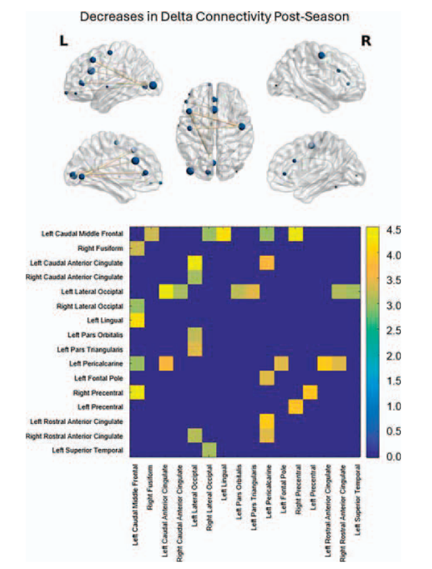 Brains of 12 year-old tackle football players  show striking abnormalities on MEG. 
A combination of regional hypo- &amp; hyperconnectivity implies compensatory changes. Authors say it's likely neural reorganization following exposure to 100's of head impacts.journals.sagepub.com/doi/epub/10.11…