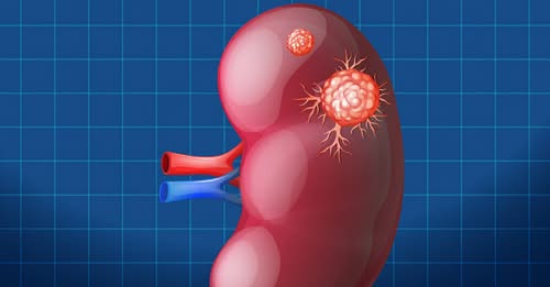 Action Kidney Cancer tweet media